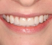 Cosmetic Dentistry - After - Birkitt Dental