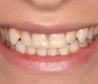Cosmetic Dentistry - Before - Birkitt Dental