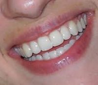 Restore Your Smile - Birkitt Dental
